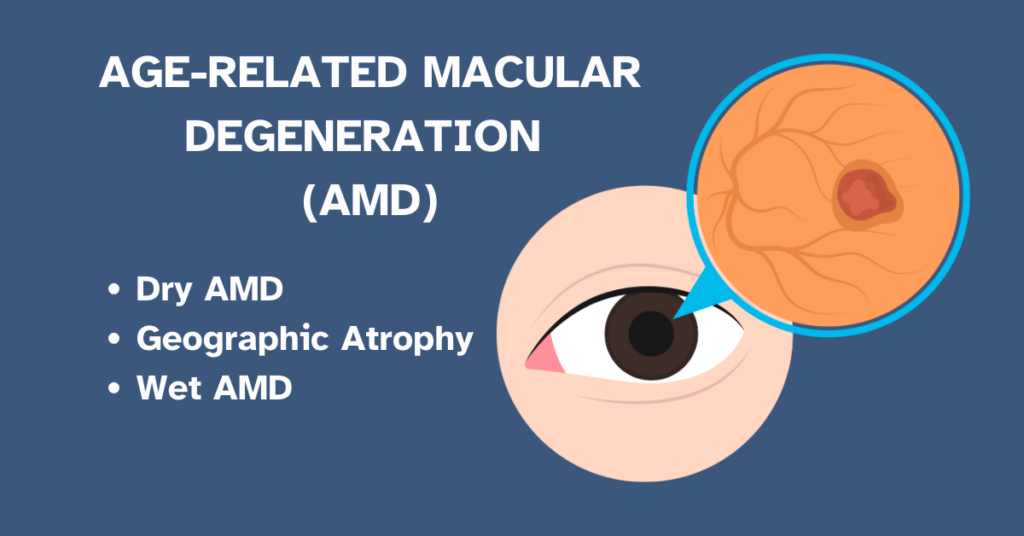 An image with text and an illustration of an eye with a magnified area showing macular degeneration