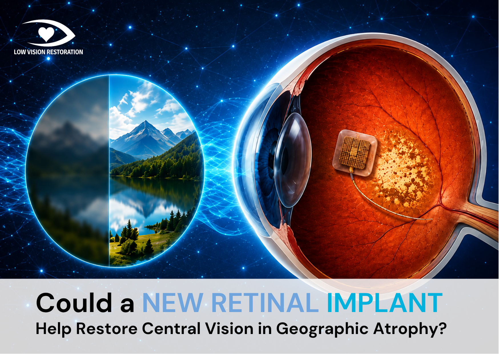 Could a New Retinal Implant Help Restore Central Vision in Geographic Atrophy?